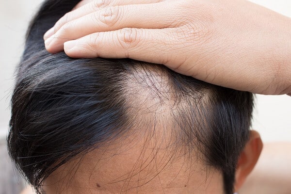 Healthy Hair Scalp - Bioscor International