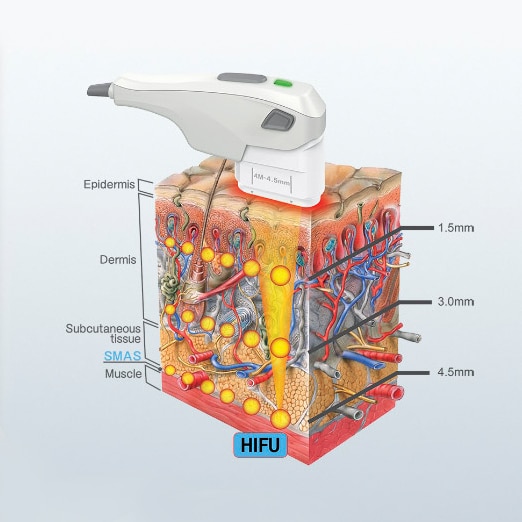 HIFU Skin Depth Treatment - Bioscor International