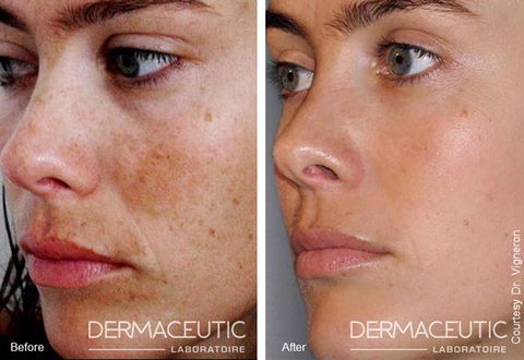 53d53da387367_-_dermaceutic-depigmentation-peel-de