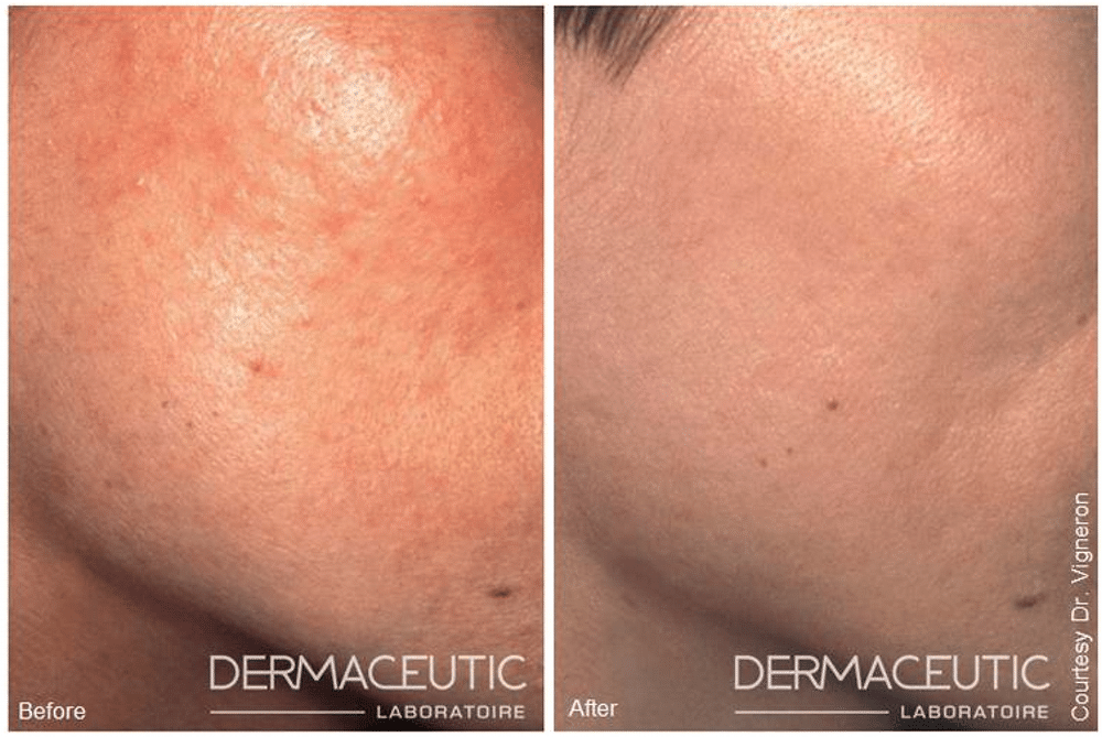 mask-peel1_1000_1024x1024