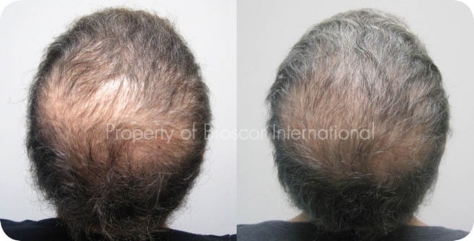 Adult Female Hair Regrowth Adult Female Losing Hair