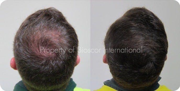 Thin Hair Men Thin Hair Men