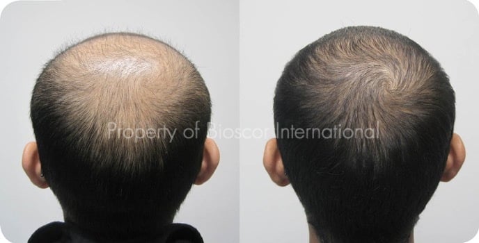 Genetic Hair Loss Genetic Hair Loss