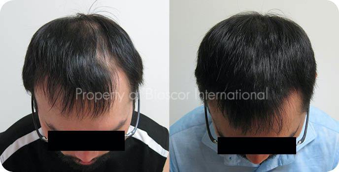 Male Pattern Baldness Male Pattern Baldness
