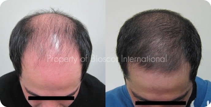 Bald Man Bald Man