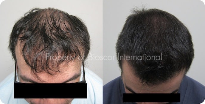 Hair Regrowth for men Hair Regrowth for men