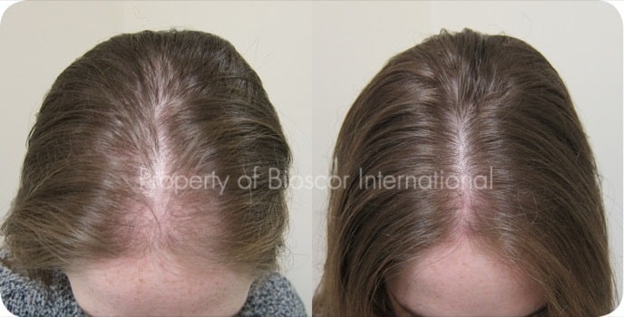 Female Hair Growth Female Hair Growth