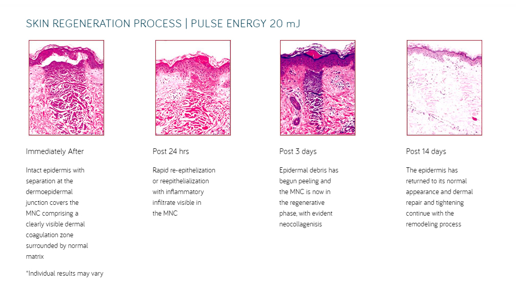 Mosaic Erbium Glass Laser Skin Regenerating non ablative melbourne skin clinic Mosaic Erbium Glass Laser Skin Regenerating non-ablative Melbourne skin clinic - Bioscor International