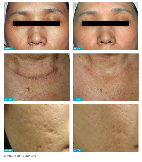 Mosaic Erbium Glass Laser Skin Rejuvenation Treatment Bioscor Melbourne Clinic Before and Afters Australia Skin Rejuvenation Treatment - Bioscor International