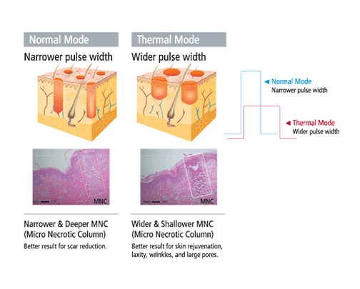 Mosaic Erbium Glass Laser Skin Resurfacing Rejuvenating non ablative melbourne skin clinic Mosaic System - Bioscor International