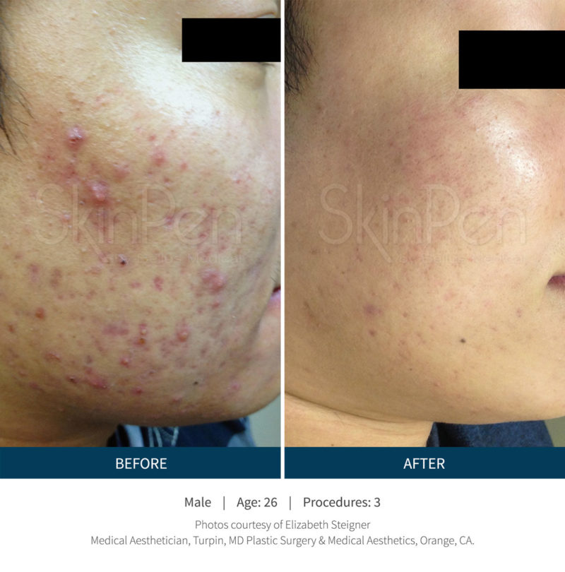 Bioscor SkinPen Bioscor International