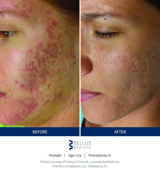 Bioscor SkinPen Bioscor International