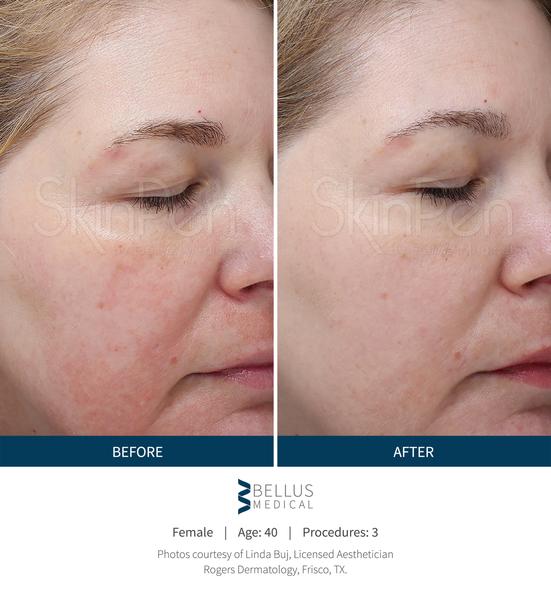 Bioscor SkinPen Bioscor International