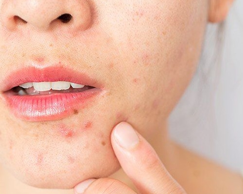 Professional Acne Treatment - Bioscor International