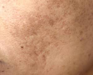 Pigmentation Treatment - Bioscor International