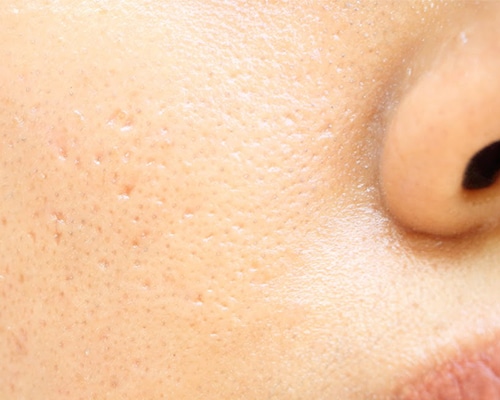 Skin Pores Treatment | Bioscor International