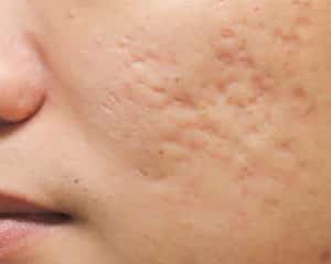 Scarring - Bioscor International