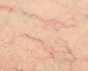Spider Veins Treatment - Bioscor International