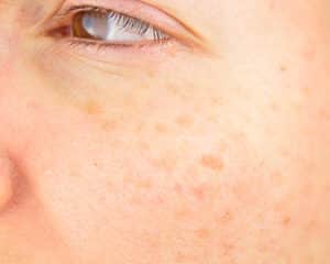 Sun spots Bioscor International