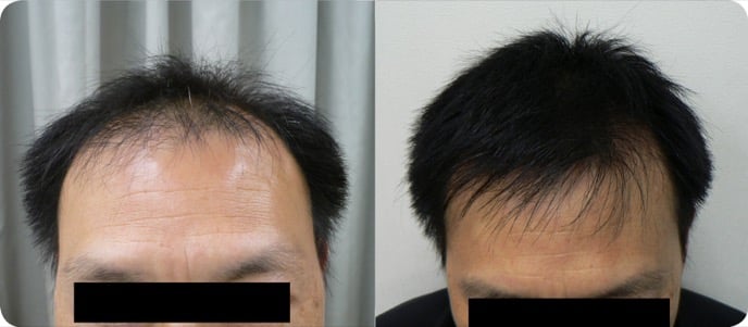 Allan Lo (SC hair regrowth) before & after3