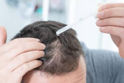 hair loss treatment