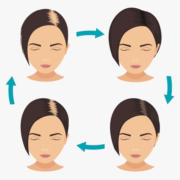 Woman with different stages of hair loss Female Pattern Baldness