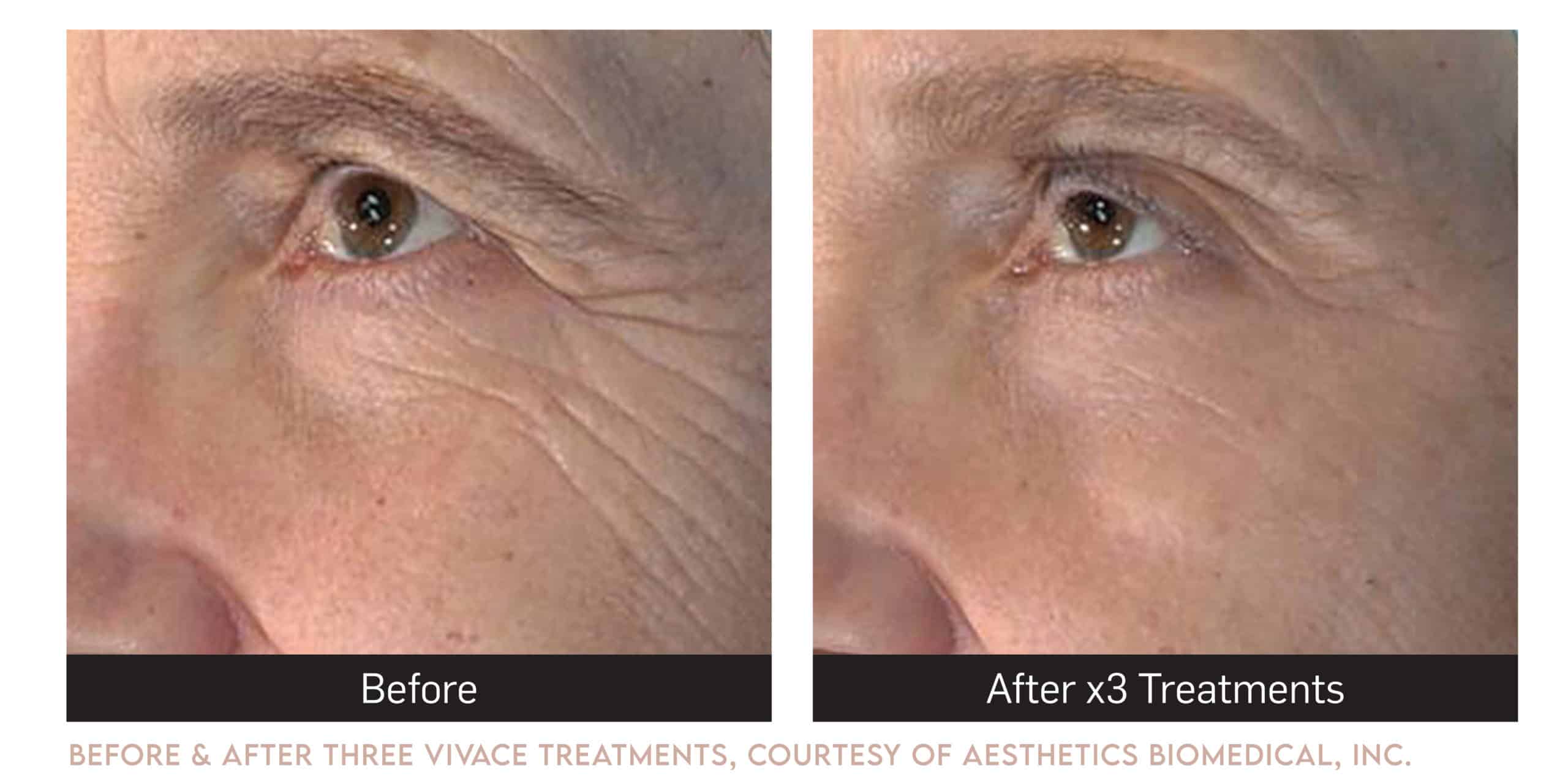 Vivace Treatment - Bioscor International
