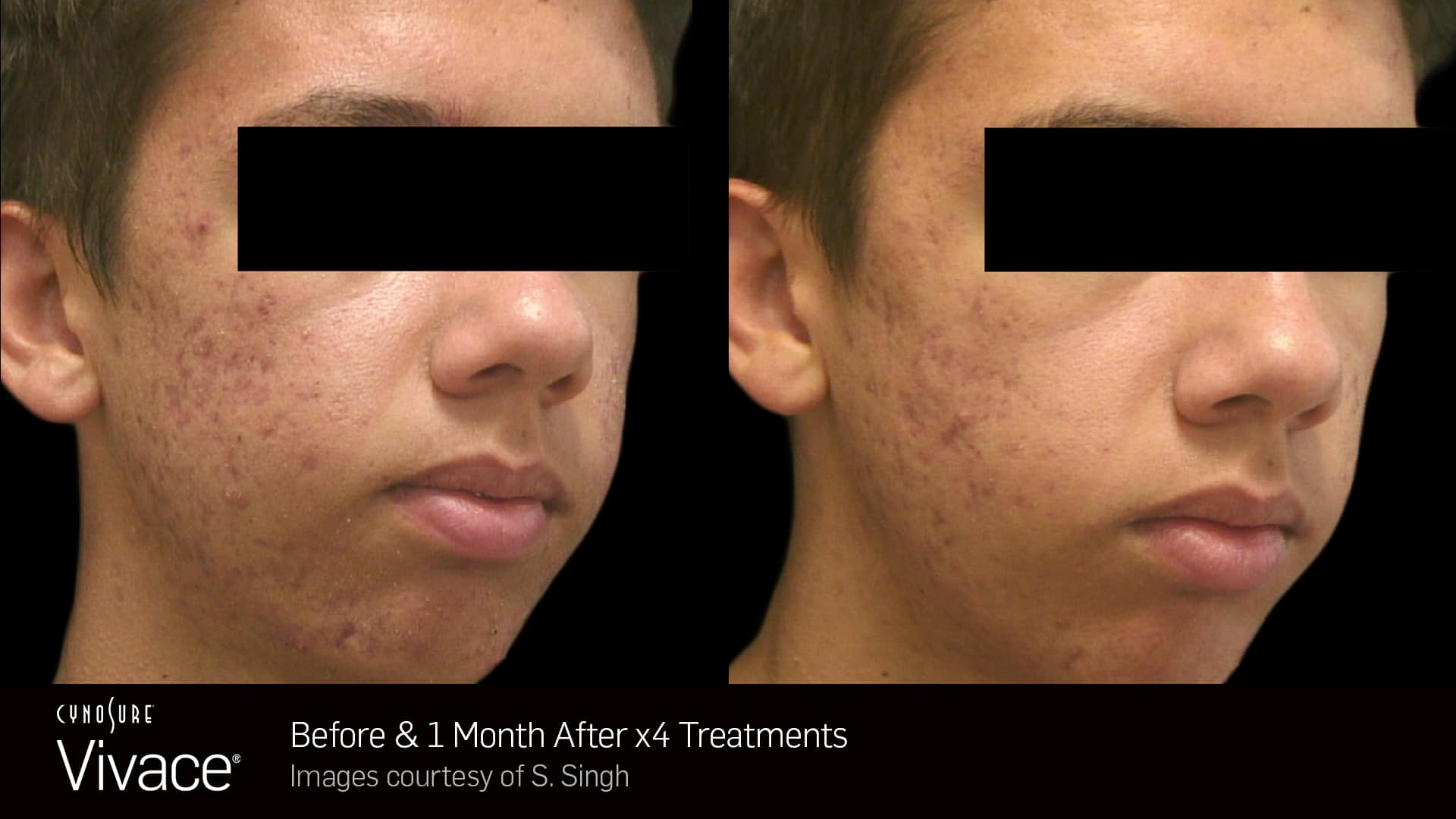 Vivace BA Ad 18 DAYS POST 1TX RIGHT - Bioscor International