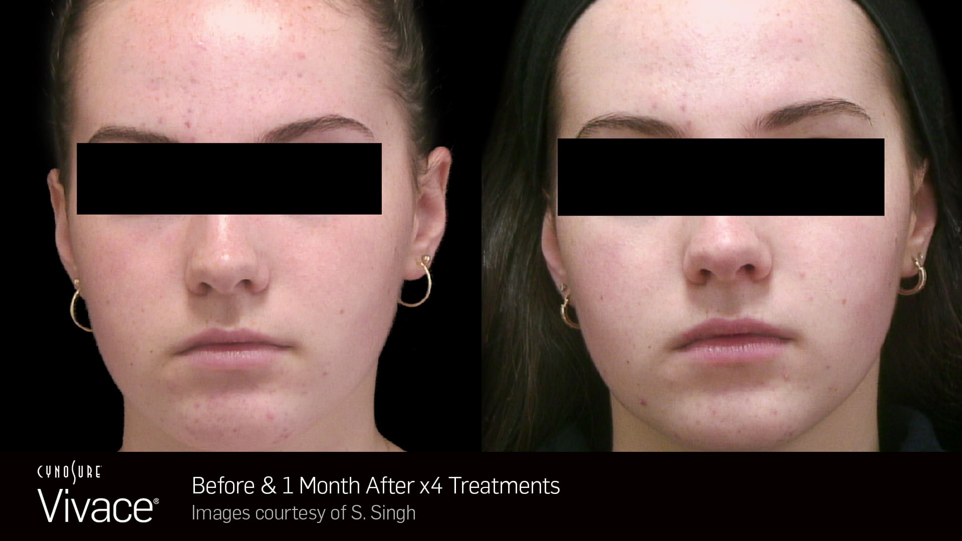vivace before & after treatment - Bioscor International