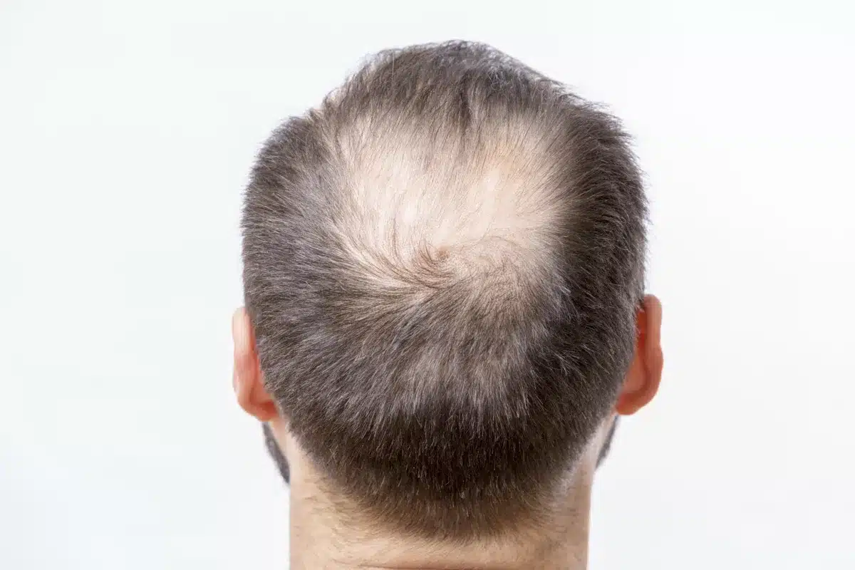 hair loss treatment