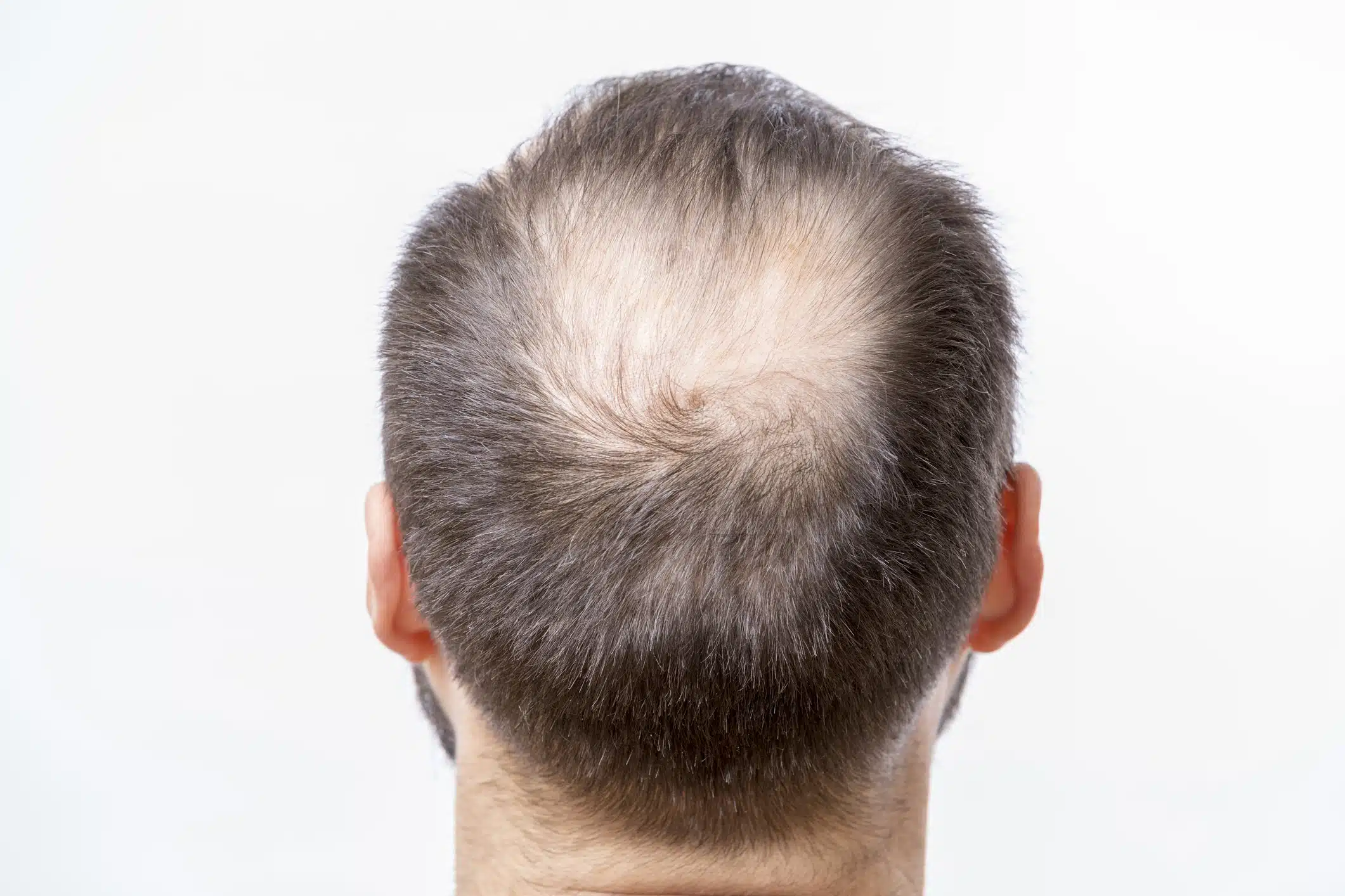 Hair loss