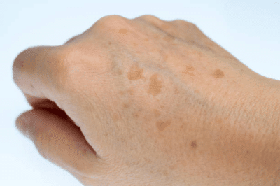 Age Spots Removal - Bioscor International