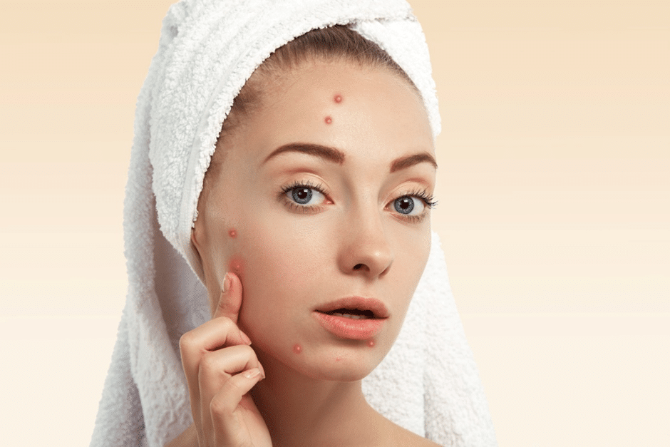 Your Go-To Guide for Acne and Acne Scarring Treatment