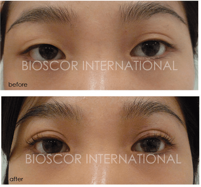 Eyelid Female - Bioscor International