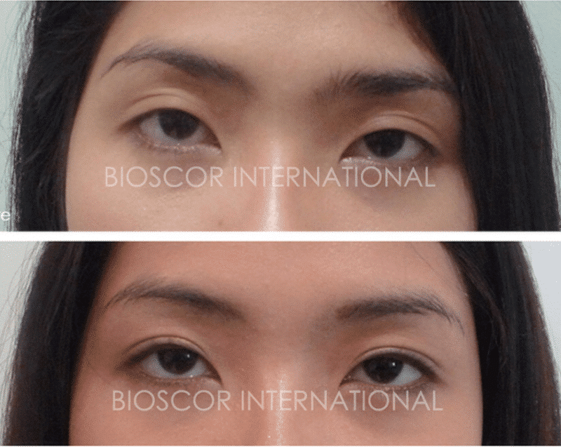 Female with Double Eyelid Stitch | Bioscor International