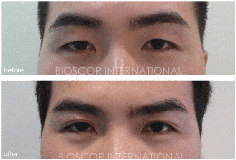 Eyelid Male - Bioscor International