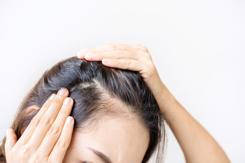 dreamstime_l_200734066 Hair loss treatment