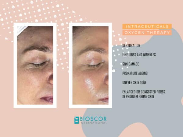 Intraceuticals Oxygen Therapy Treatments/Oxygen