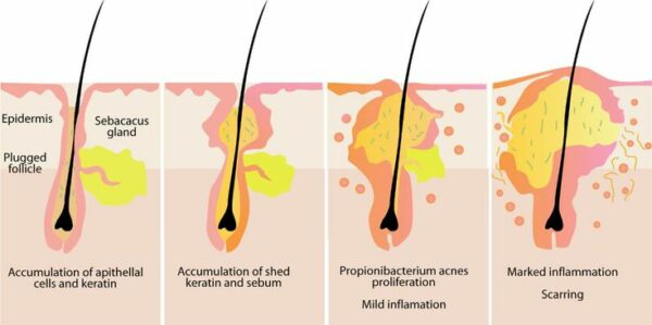 Acne Tretment - Bioscor International 
