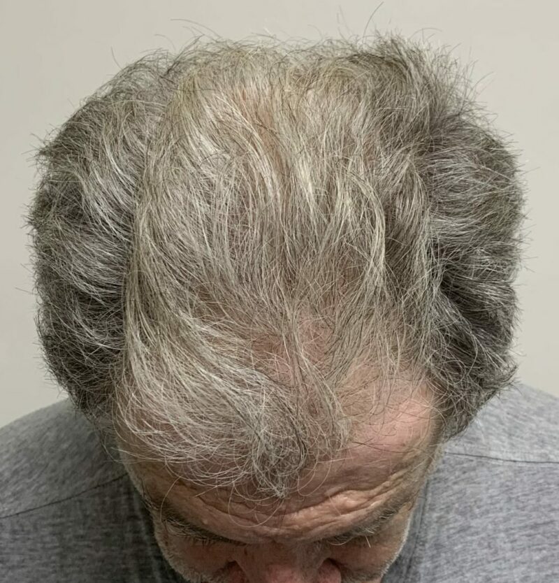 Exosomes for Hair - Bioscor International