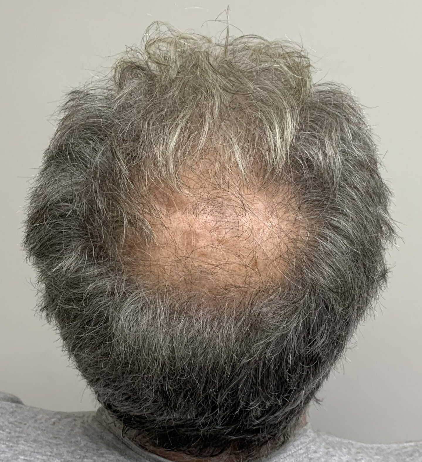 Exosomes for Hair - Bioscor International