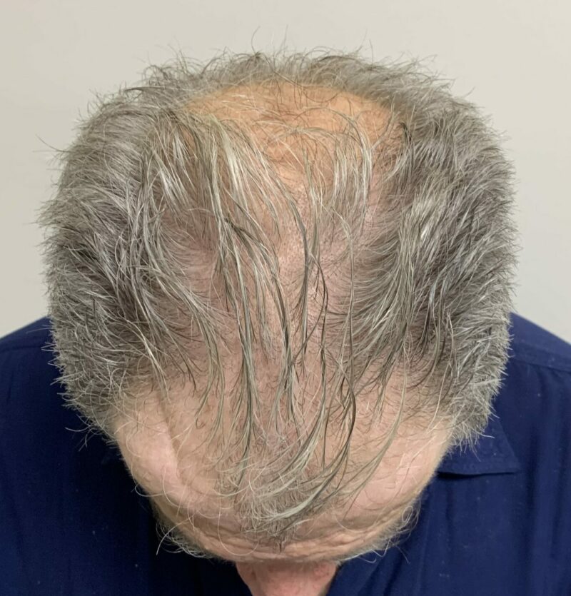 Exosomes for Hair - Bioscor International