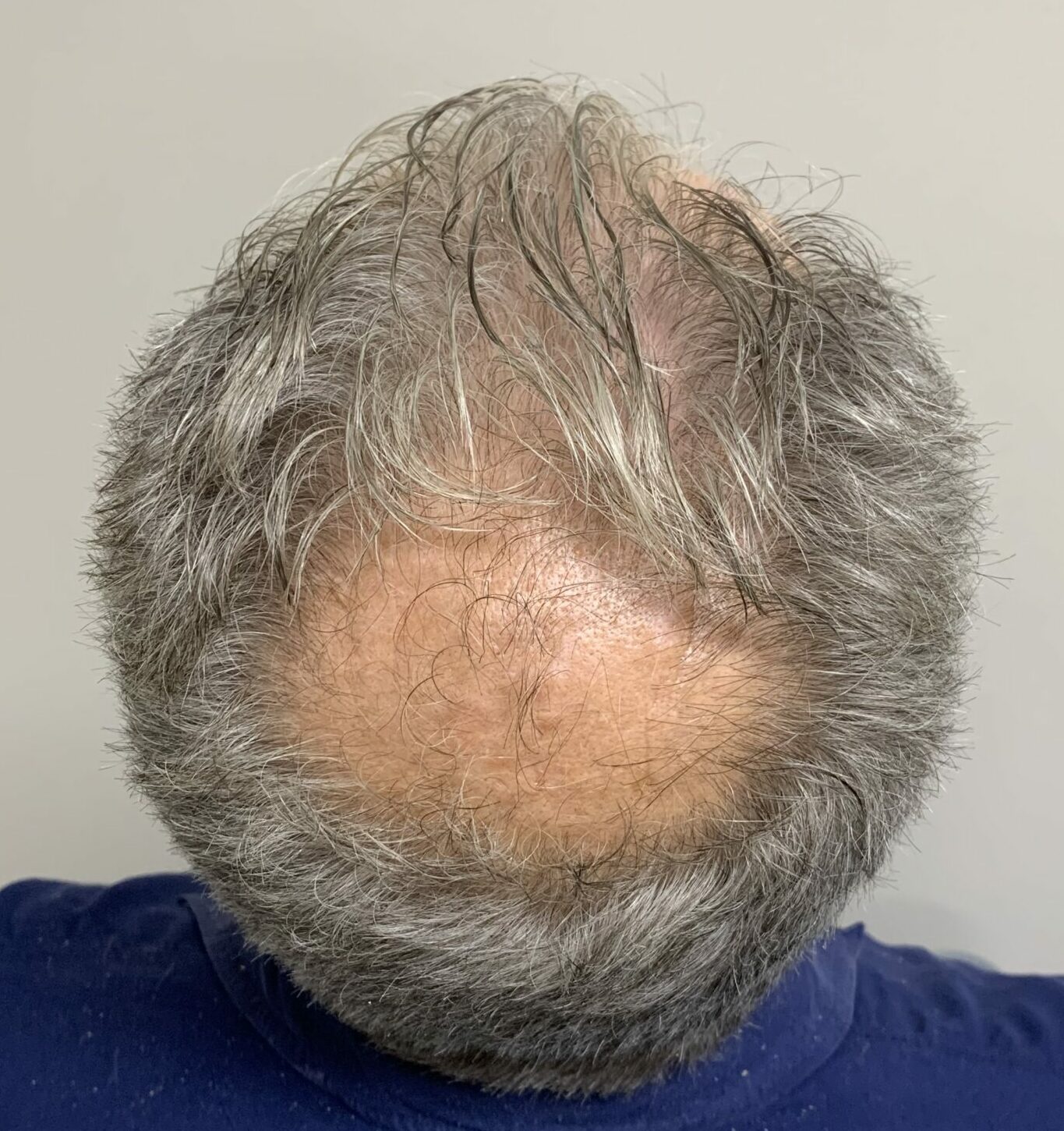 Exosomes for Hair - Bioscor International