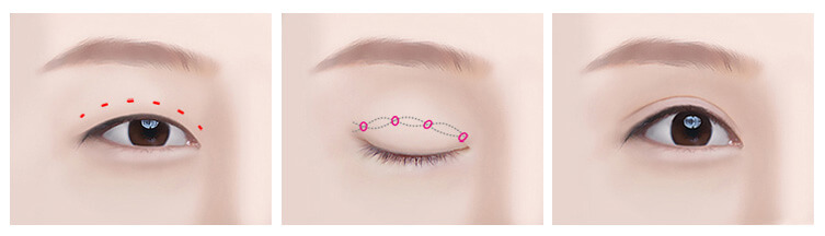 Double Eyelid Stitch Procedure | Bioscor International