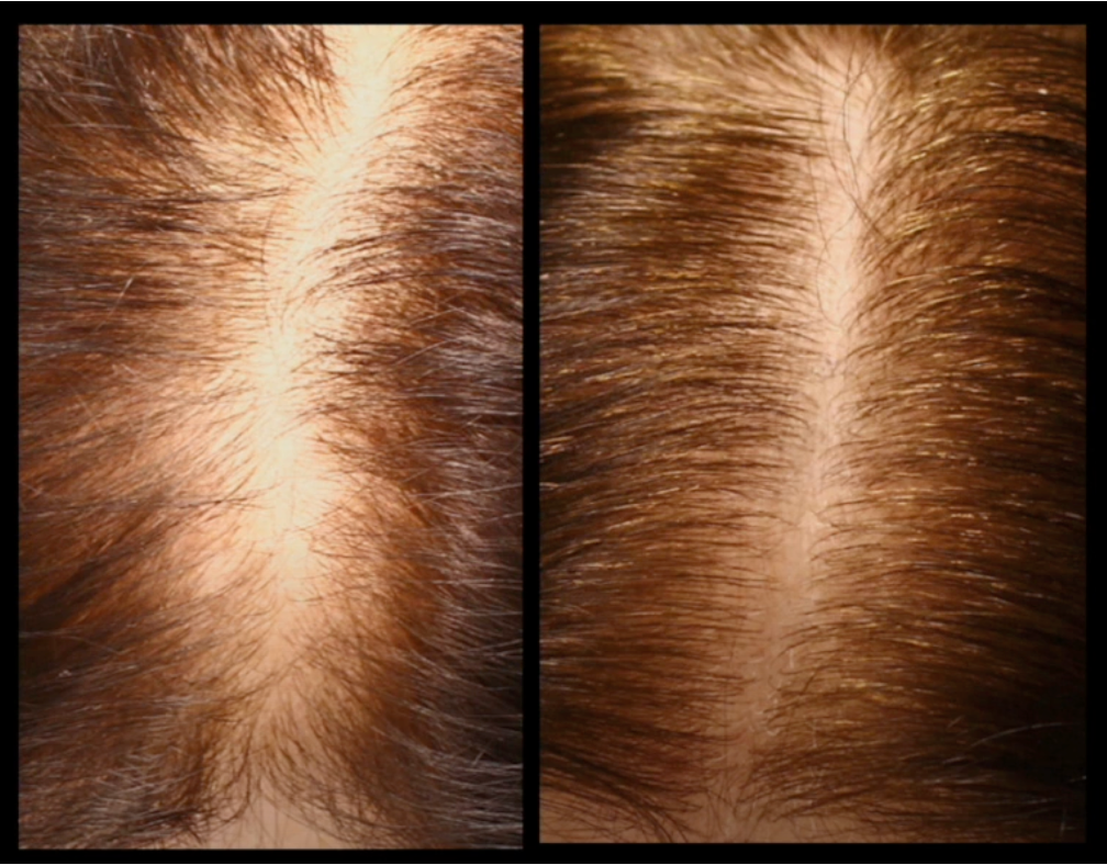 PRF (Platelet-Rich Fibrin) for Hair Loss