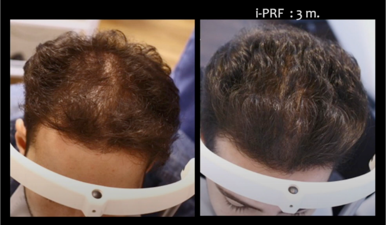 PRF Male Results | Bioscor International