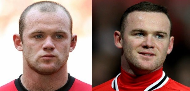 wayne-rooney Hair Loss Treatment For Men - Bioscor International