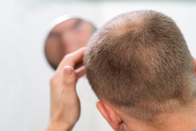 hair loss treatment